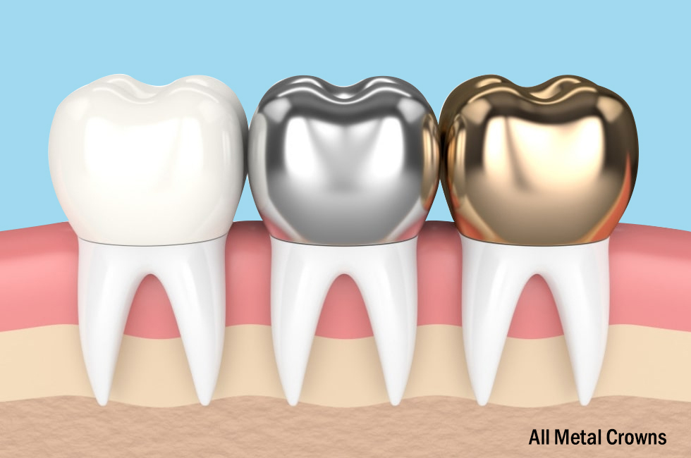 Crown and Bridgework