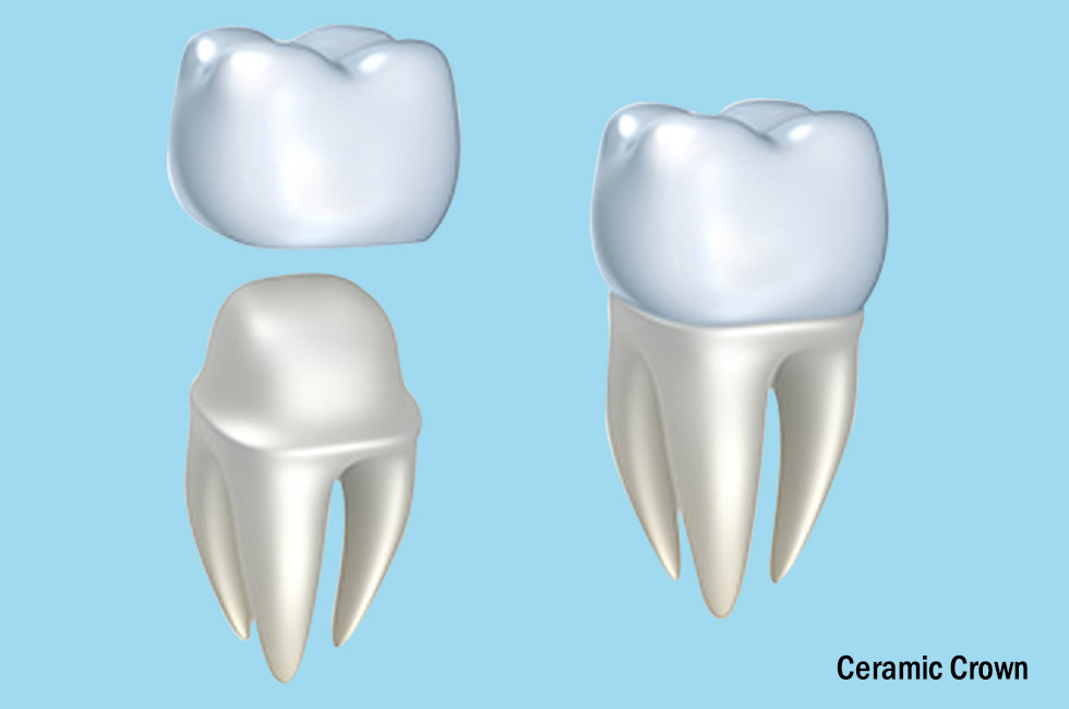 Crown and Bridgework