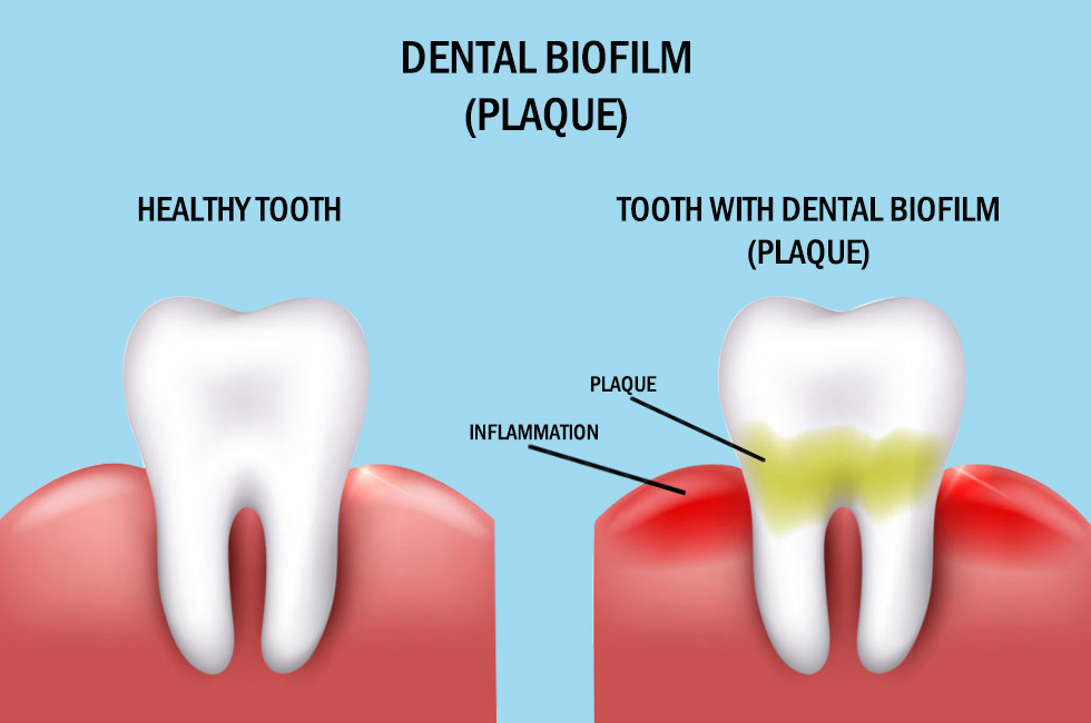 dental Cleaning