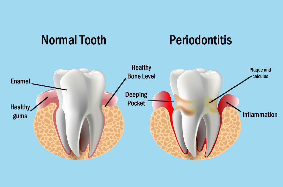 dental Cleaning