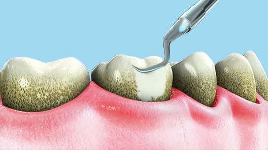 dental Cleaning