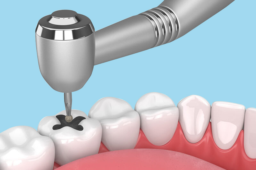 Dental Filling