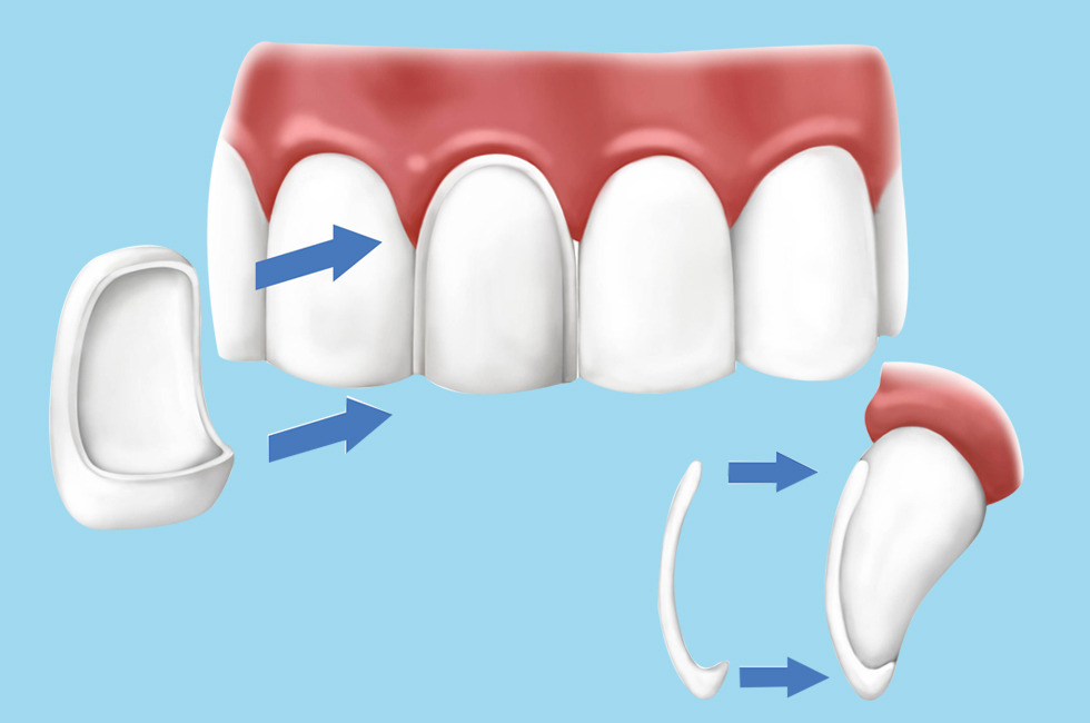 Porcelain and Composite Veneers