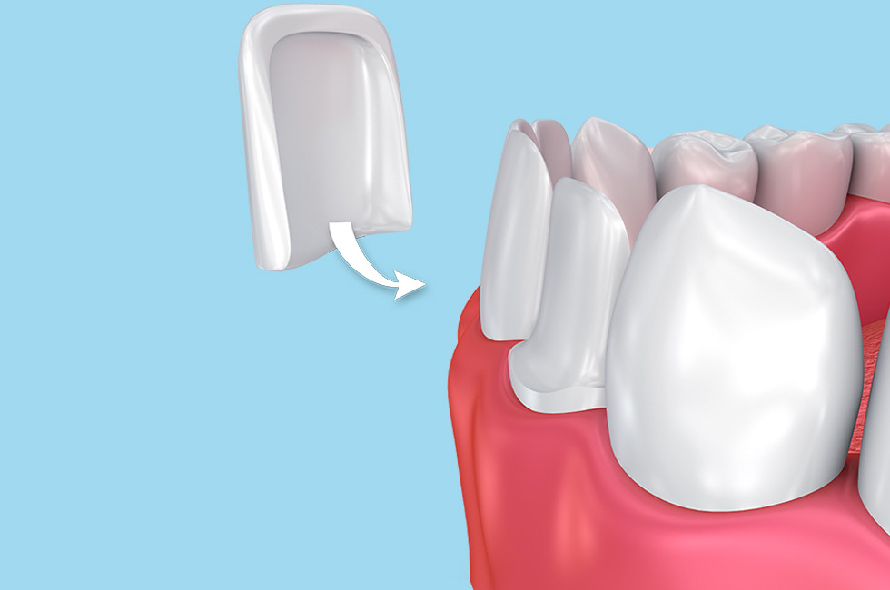 Porcelain and Composite Veneers