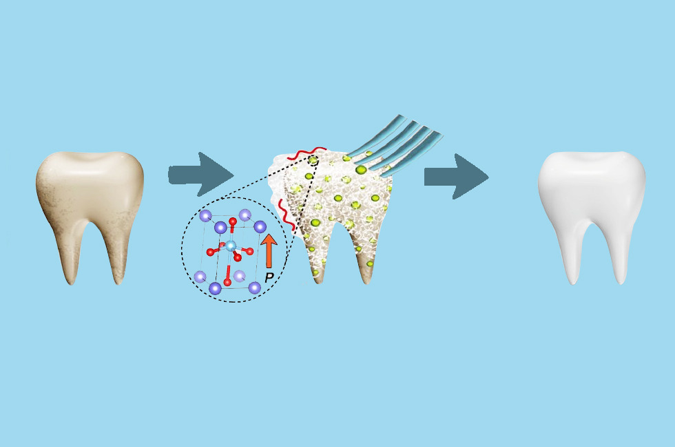 Teeth Whitening or Bleaching
