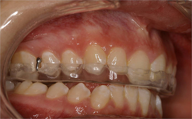 Occlusal Splints